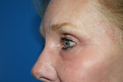Laser Skin Resurfacing Before & After Gallery - Patient 223623 - Image 2