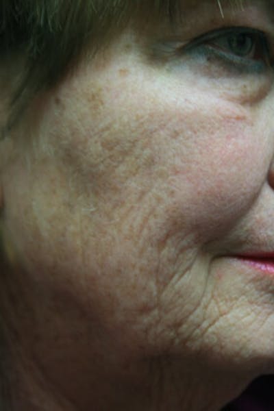 Laser Skin Resurfacing Before & After Gallery - Patient 171922 - Image 1