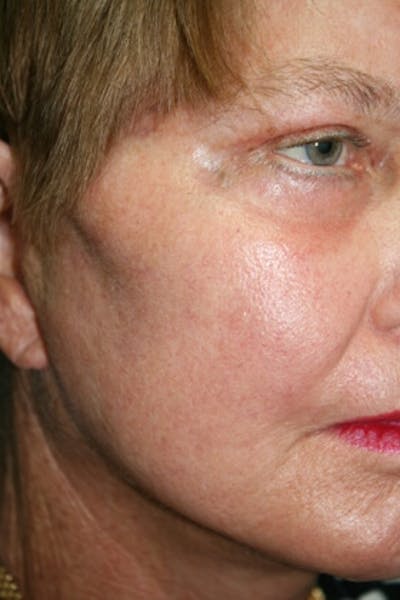 Laser Skin Resurfacing Before & After Gallery - Patient 171922 - Image 2