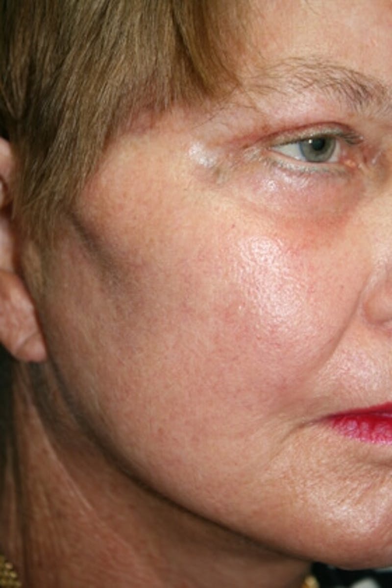 Laser Skin Resurfacing Before & After Gallery - Patient 171922 - Image 2