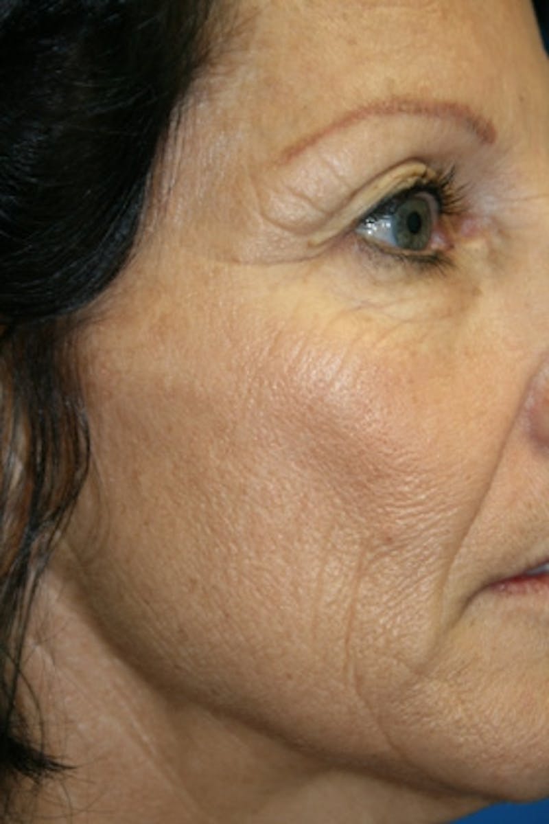 Laser Skin Resurfacing Before & After Gallery - Patient 428762 - Image 1