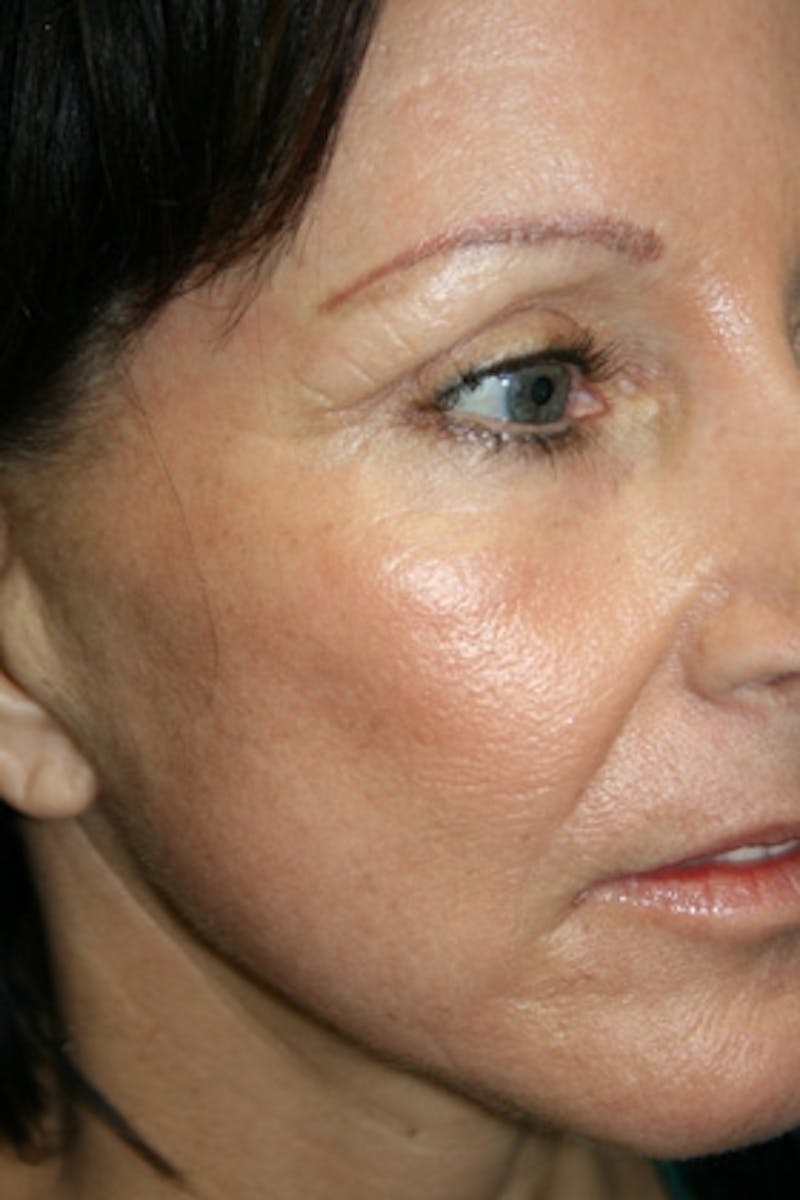Laser Skin Resurfacing Before & After Gallery - Patient 428762 - Image 2