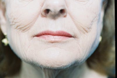 Laser Skin Resurfacing Before & After Gallery - Patient 384021 - Image 1
