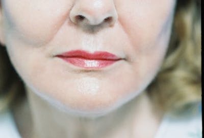 Laser Skin Resurfacing Before & After Gallery - Patient 384021 - Image 2