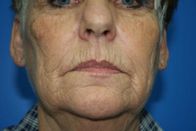 Laser Skin Resurfacing Before & After Gallery - Patient 307964 - Image 1
