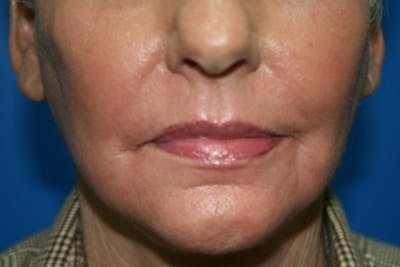 Laser Skin Resurfacing Before & After Gallery - Patient 307964 - Image 2