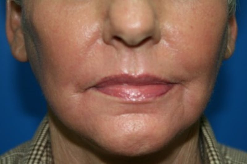 Laser Skin Resurfacing Before & After Gallery - Patient 307964 - Image 2