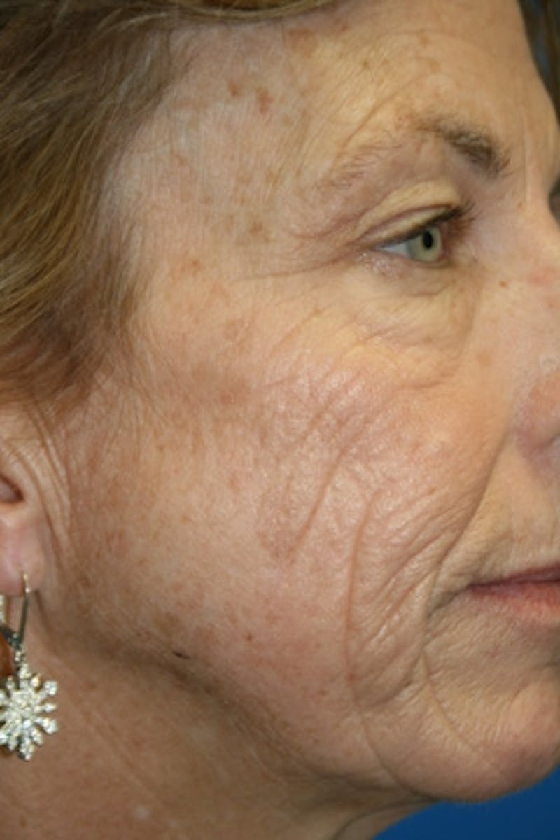 Laser Skin Resurfacing Before & After Gallery - Patient 372191 - Image 1