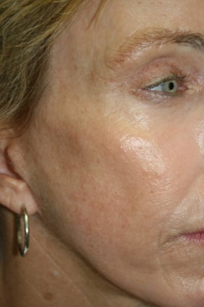 Laser Skin Resurfacing Before & After Gallery - Patient 372191 - Image 2
