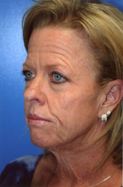 Laser Skin Resurfacing Before & After Gallery - Patient 104894 - Image 1