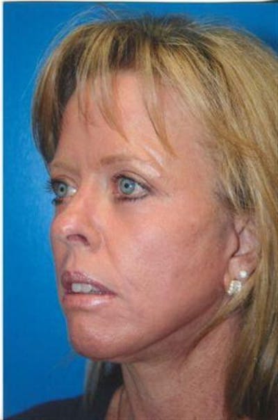 Laser Skin Resurfacing Before & After Gallery - Patient 104894 - Image 2