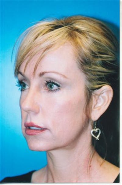 Facial Implants (Chin, Cheek, Midface) Before & After Gallery - Patient 235197 - Image 1