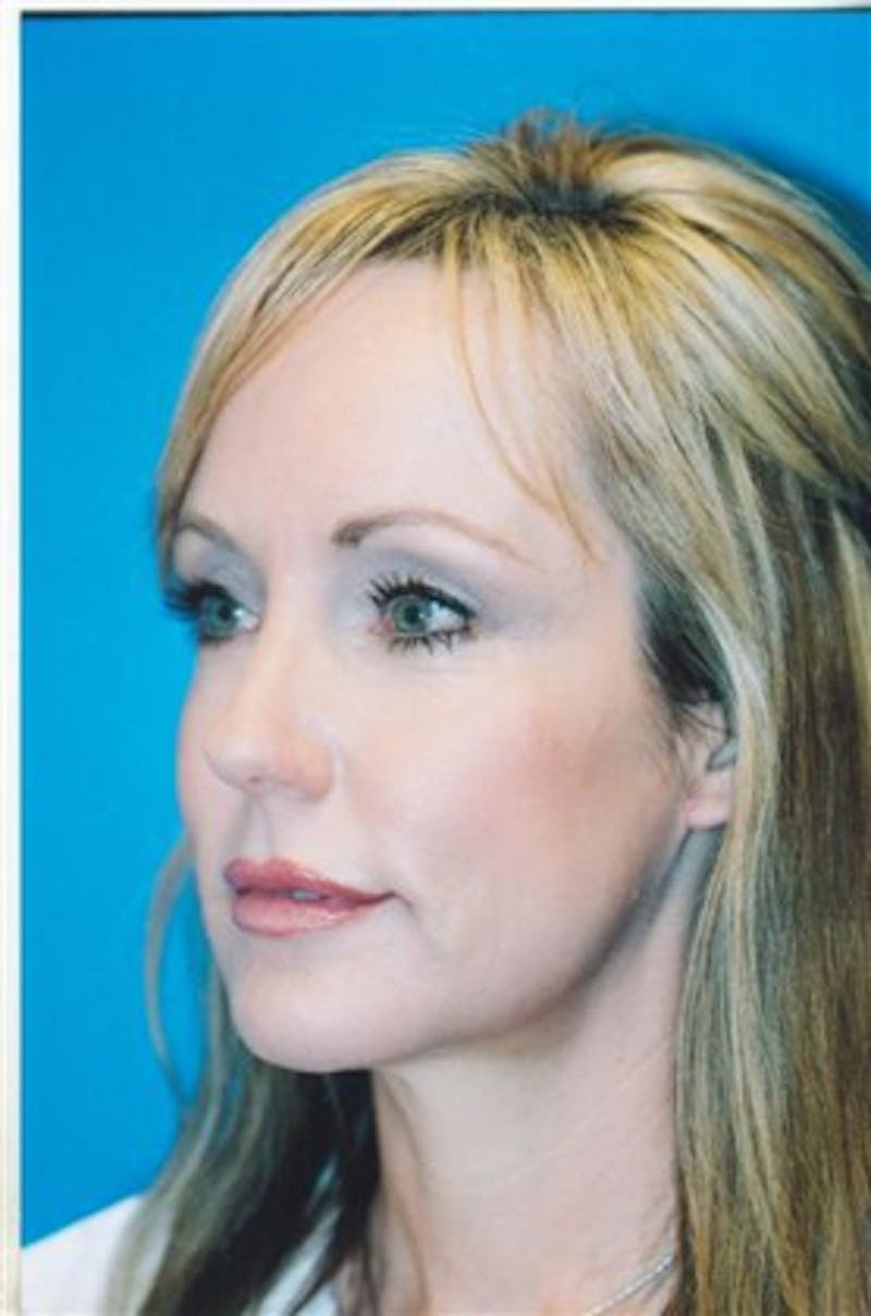 Facial Implants (Chin, Cheek, Midface) Before & After Gallery - Patient 235197 - Image 2