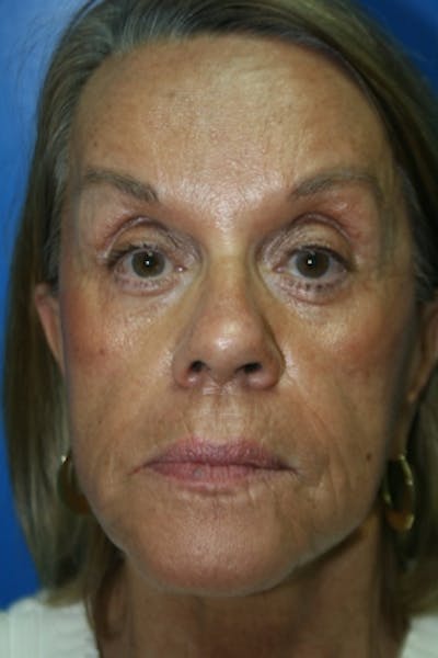 Facial Implants (Chin, Cheek, Midface) Before & After Gallery - Patient 304534 - Image 1