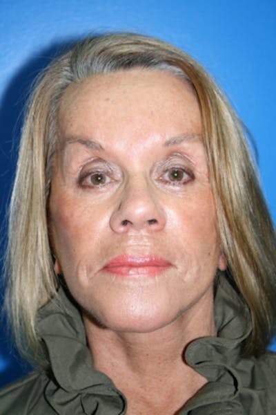 Facial Implants (Chin, Cheek, Midface) Before & After Gallery - Patient 304534 - Image 2