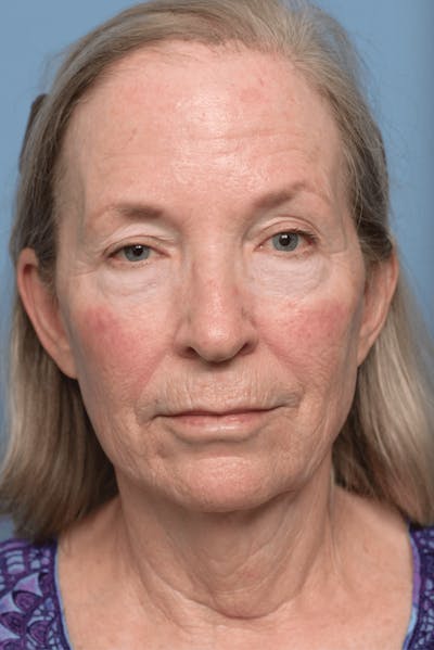 Deep Plane Facelift Before & After Gallery - Patient 220842 - Image 1