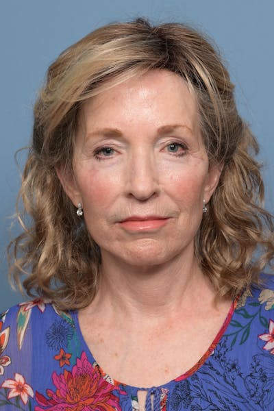 Deep Plane Facelift Before & After Gallery - Patient 220842 - Image 2