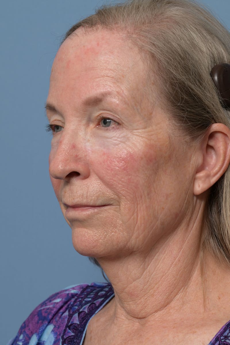 Deep Plane Facelift Before & After Gallery - Patient 220842 - Image 3