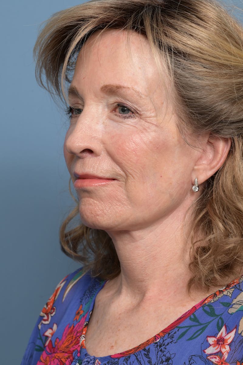 Deep Plane Facelift Before & After Gallery - Patient 220842 - Image 4