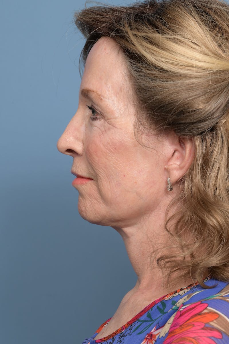 Deep Plane Facelift Before & After Gallery - Patient 220842 - Image 6