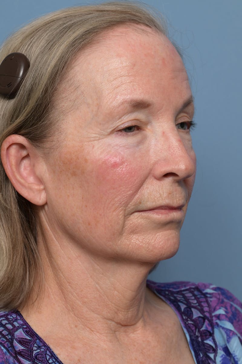Deep Plane Facelift Before & After Gallery - Patient 220842 - Image 7