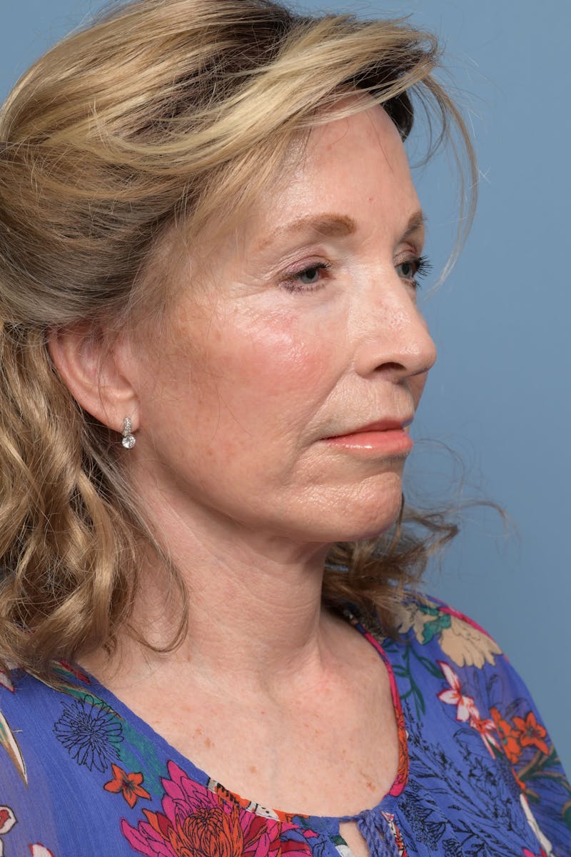 Deep Plane Facelift Before & After Gallery - Patient 220842 - Image 8