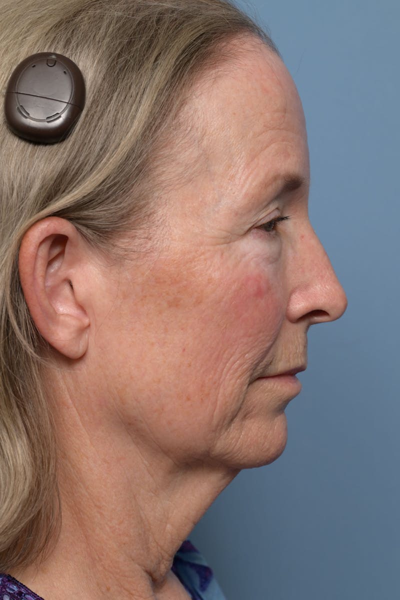 Deep Plane Facelift Before & After Gallery - Patient 220842 - Image 9