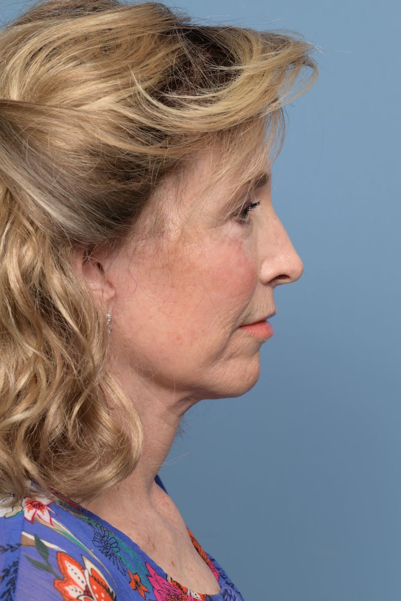 Deep Plane Facelift Before & After Gallery - Patient 220842 - Image 10