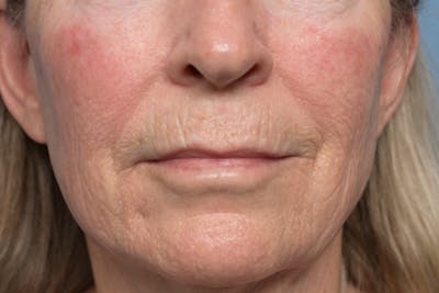 Lip Lift Before & After Gallery - Patient 211463 - Image 1