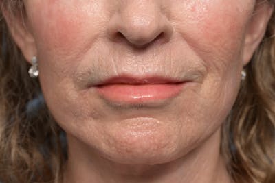 Lip Lift Before & After Gallery - Patient 211463 - Image 2