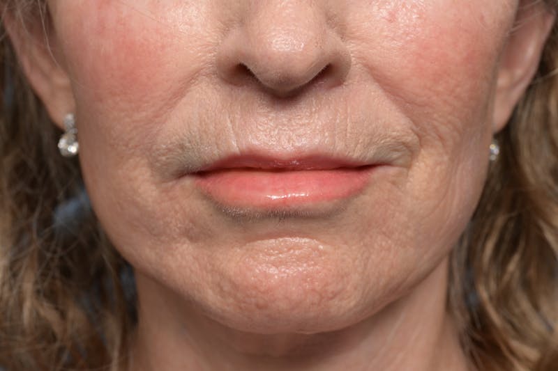 Lip Lift Before & After Gallery - Patient 211463 - Image 2