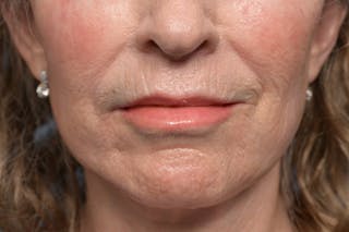 Lip Lift Before & After Gallery - Patient 211463 - Image 2