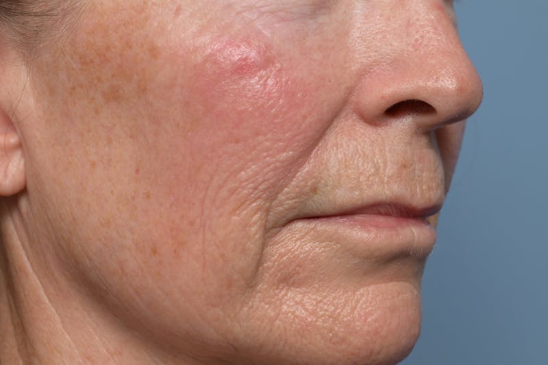 Lip Lift Before & After Gallery - Patient 211463 - Image 3