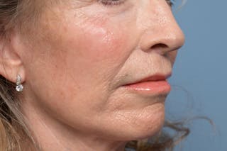 Lip Lift Before & After Gallery - Patient 211463 - Image 4