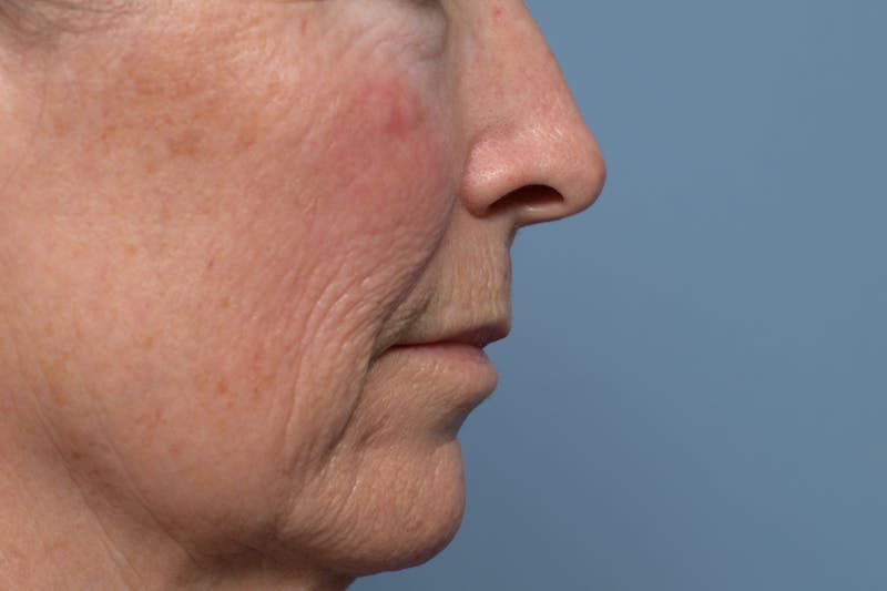 Lip Lift Before & After Gallery - Patient 211463 - Image 5