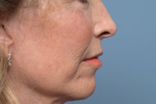 Lip Lift Before & After Gallery - Patient 211463 - Image 6