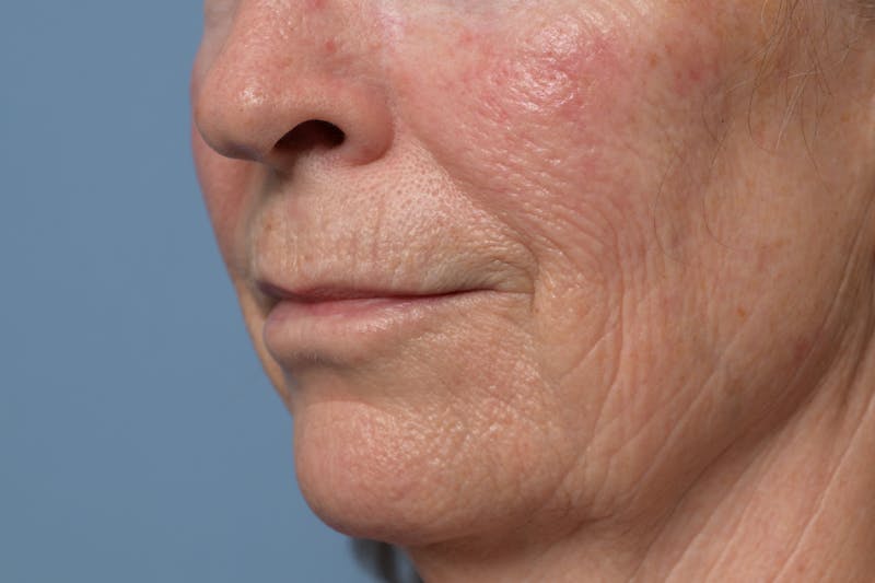 Lip Lift Before & After Gallery - Patient 211463 - Image 7