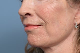 Lip Lift Before & After Gallery - Patient 211463 - Image 8