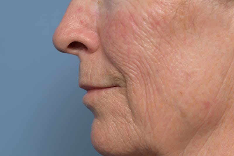 Lip Lift Before & After Gallery - Patient 211463 - Image 9