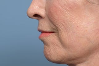 Lip Lift Before & After Gallery - Patient 211463 - Image 10