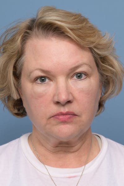 Deep Plane Facelift Before & After Gallery - Patient 394661 - Image 1