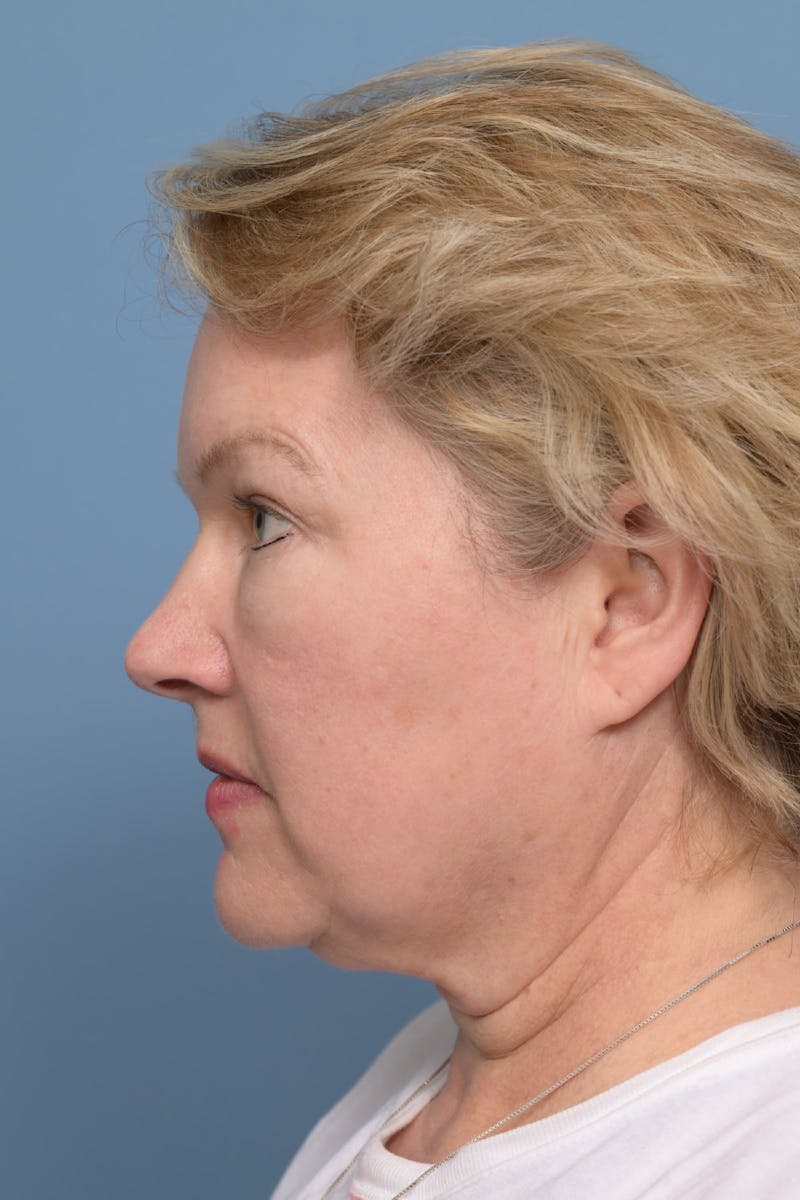 Neck Lift Before & After Gallery - Patient 369023 - Image 3