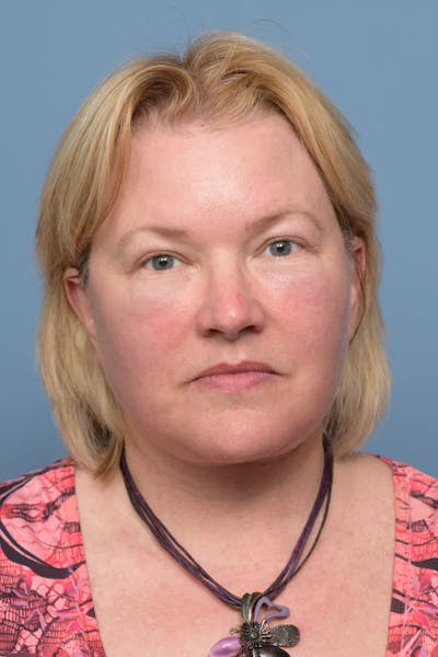 Deep Plane Facelift Before & After Gallery - Patient 394661 - Image 2