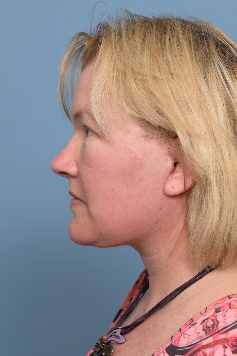 Neck Lift Before & After Gallery - Patient 369023 - Image 4
