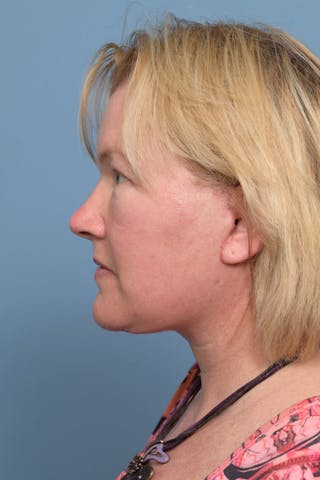 Buccal Fat Excision Before & After Gallery - Patient 148150 - Image 4