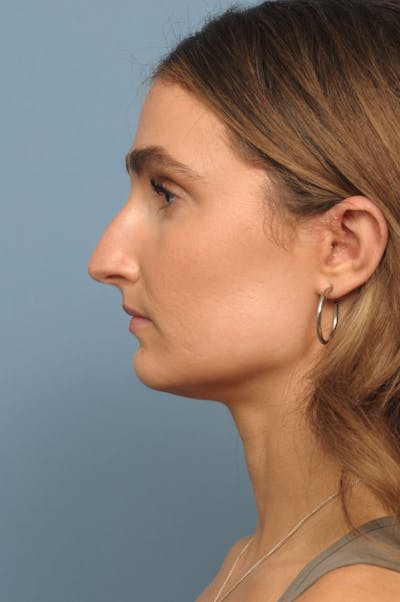 Rhinoplasty Before & After Gallery - Patient 236933 - Image 1