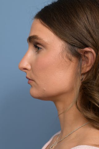 Rhinoplasty Before & After Gallery - Patient 236933 - Image 2