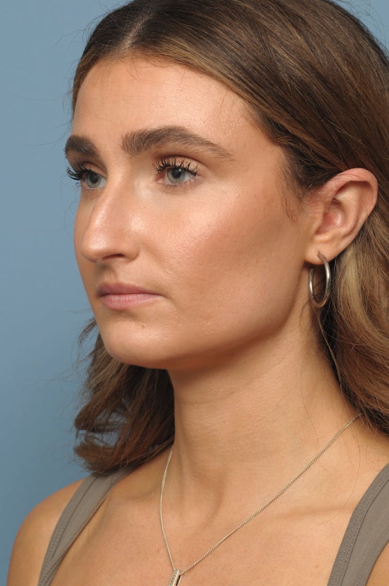 Rhinoplasty Before & After Gallery - Patient 236933 - Image 3