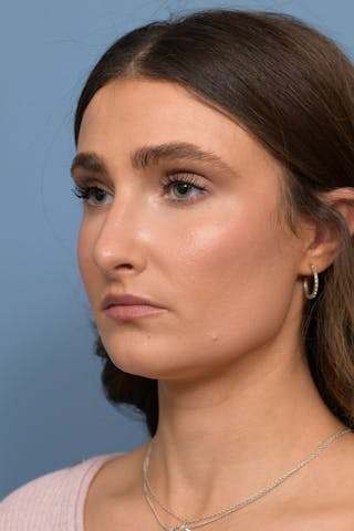 Rhinoplasty Before & After Gallery - Patient 236933 - Image 4
