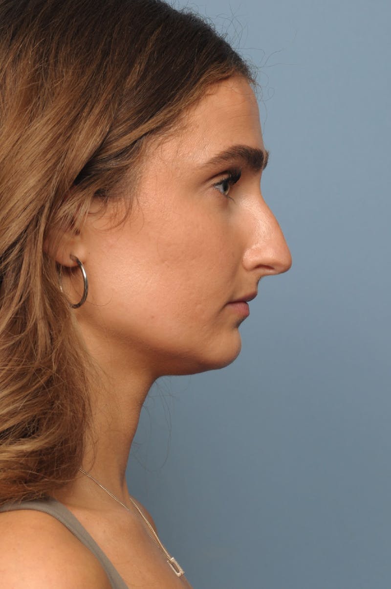 Rhinoplasty Before & After Gallery - Patient 236933 - Image 5